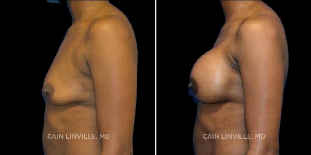 Breast Augmentation Before & After Gallery - Patient 8523126 - Image 3