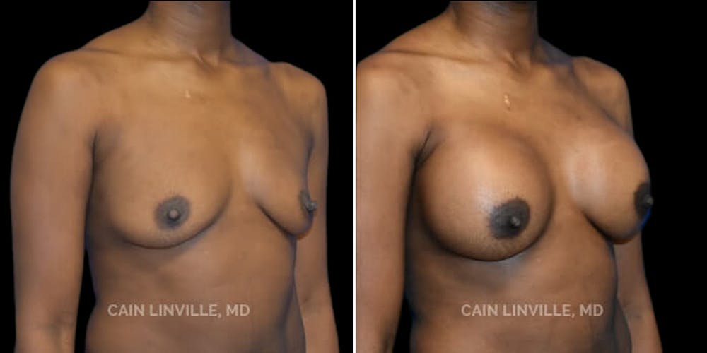 Breast Augmentation Before & After Gallery - Patient 8523126 - Image 4