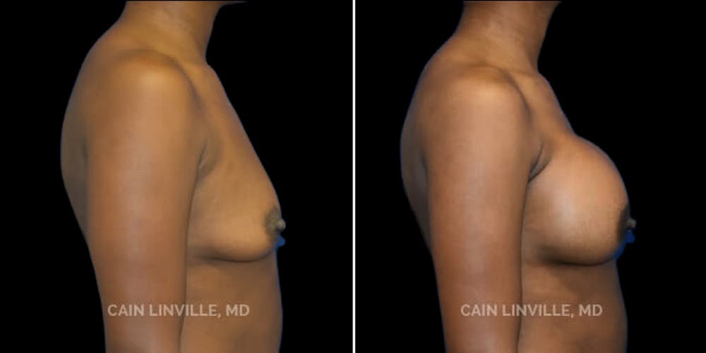 Breast Augmentation Before & After Gallery - Patient 8523126 - Image 5