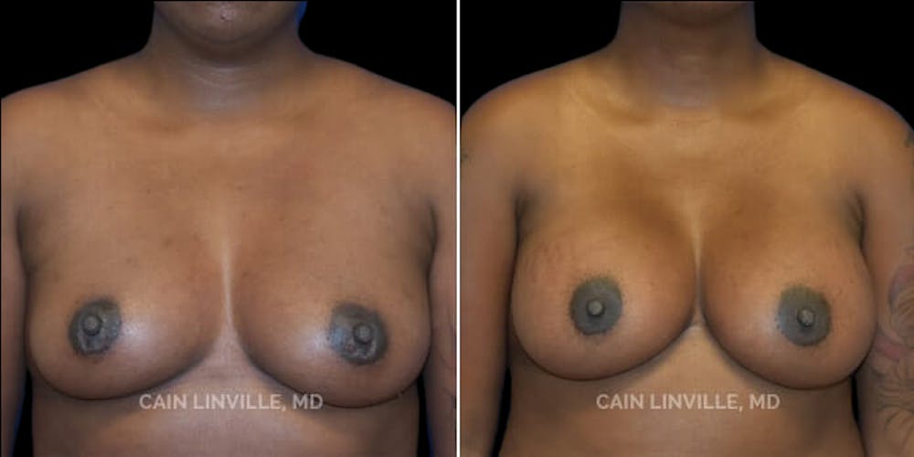 Breast Augmentation Before & After Gallery - Patient 8523105 - Image 1
