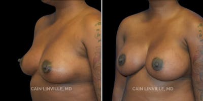 Breast Augmentation Before & After Gallery - Patient 8523105 - Image 2