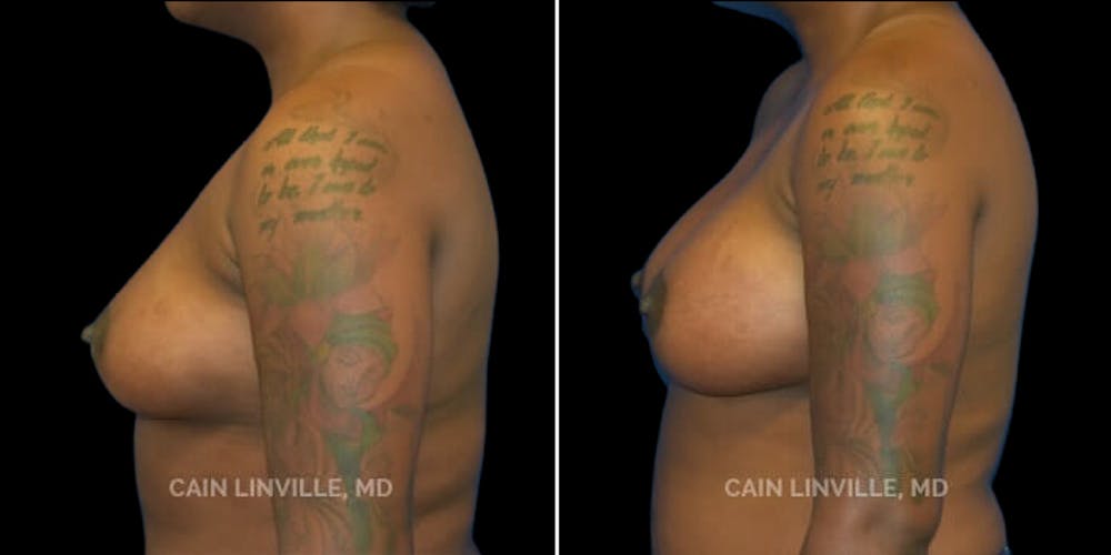 Breast Augmentation Before & After Gallery - Patient 8522912 - Image 5