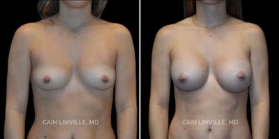 Breast Augmentation Before & After Gallery - Patient 8523161 - Image 1