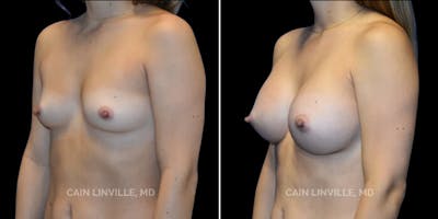 Breast Augmentation Before & After Gallery - Patient 8523161 - Image 2