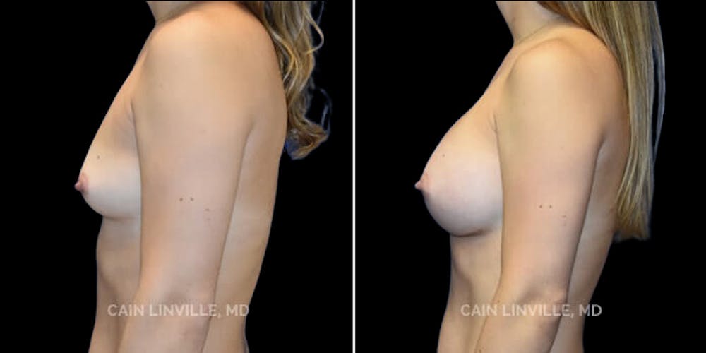 Breast Augmentation Before & After Gallery - Patient 8523161 - Image 3