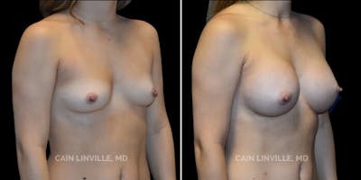 Breast Augmentation Before & After Gallery - Patient 8523161 - Image 4