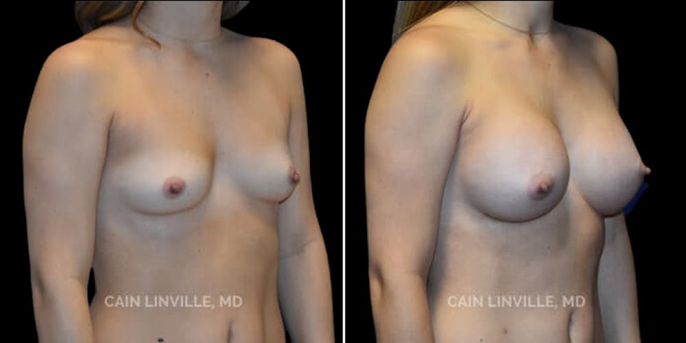 Breast Augmentation Before & After Gallery - Patient 8523161 - Image 4