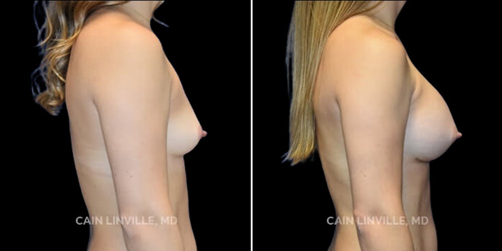 Breast Augmentation Before & After Gallery - Patient 8523161 - Image 5