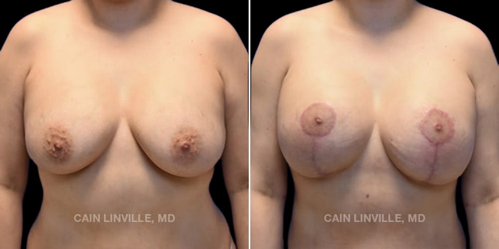 Breast Revision Before & After Gallery - Patient 48689808 - Image 1