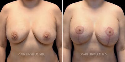 Breast Revision Before & After Gallery - Patient 48689808 - Image 1
