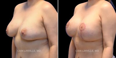Breast Revision Before & After Gallery - Patient 48689808 - Image 2