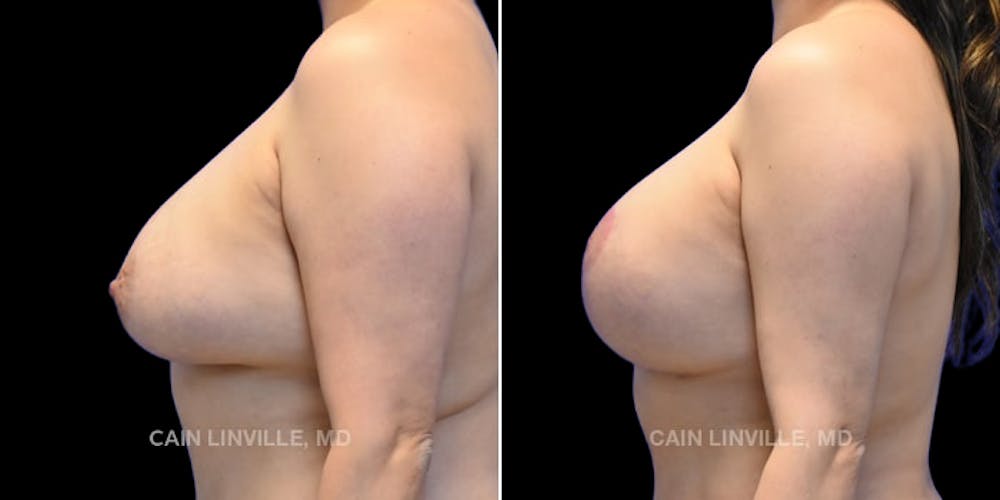 Breast Revision Before & After Gallery - Patient 48689808 - Image 3