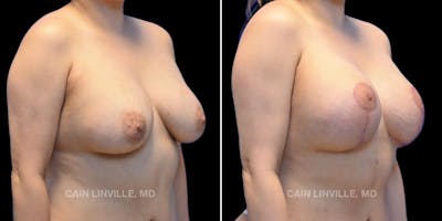 Breast Revision Before & After Gallery - Patient 48689808 - Image 4