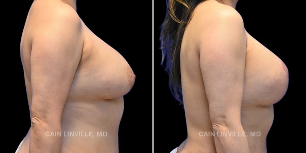 Breast Revision Before & After Gallery - Patient 48689808 - Image 5