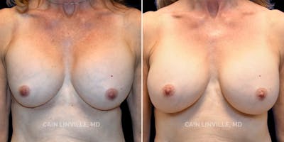 Breast Revision Before & After Gallery - Patient 48689809 - Image 1