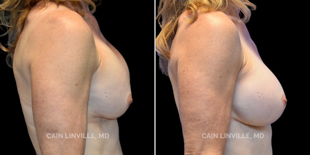 Breast Revision Before & After Gallery - Patient 48689809 - Image 2
