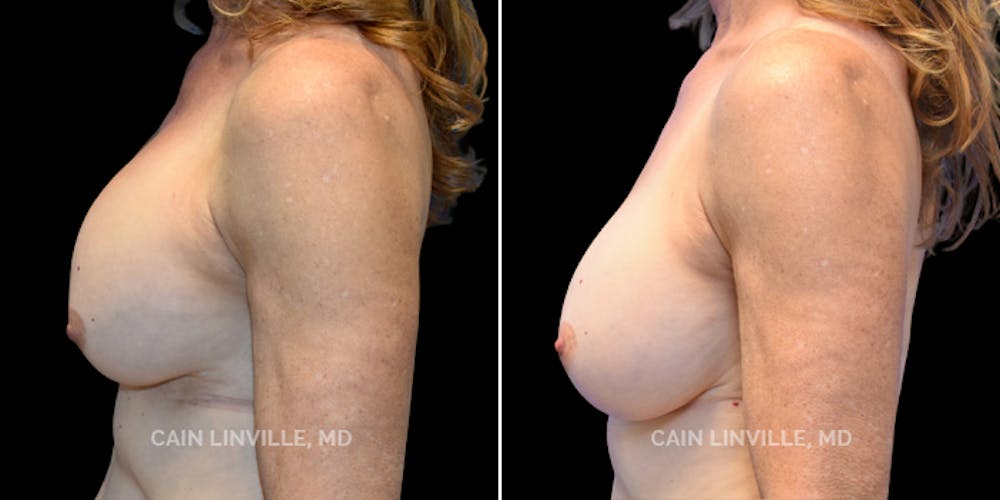 Breast Revision Before & After Gallery - Patient 48689809 - Image 3