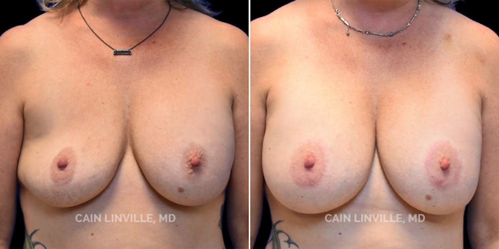 Breast Revision Before & After Gallery - Patient 48689810 - Image 1