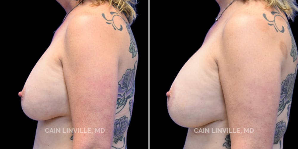 Breast Revision Before & After Gallery - Patient 48689810 - Image 3