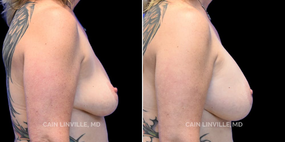 Breast Revision Before & After Gallery - Patient 48689810 - Image 5