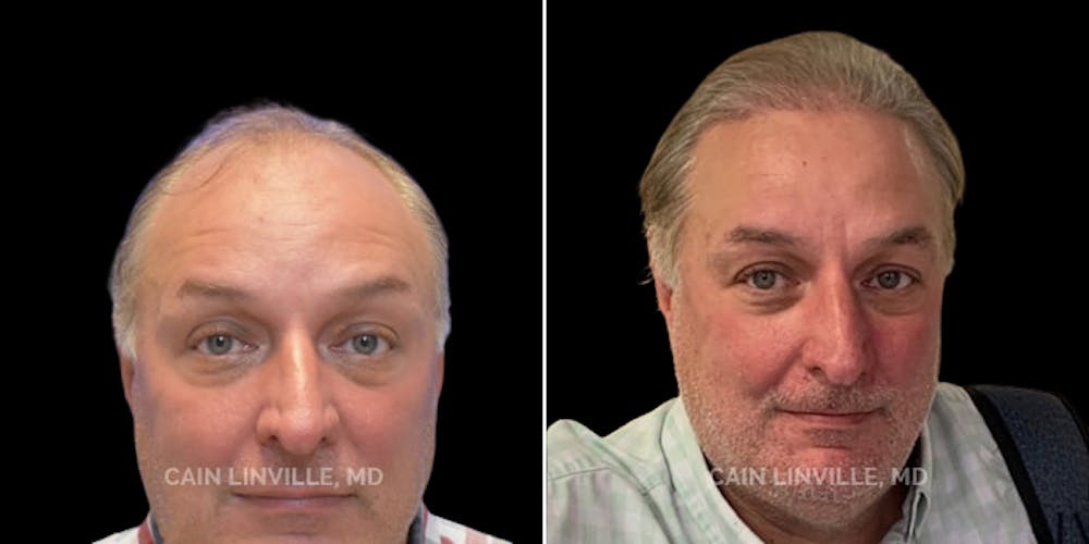 Hair Restoration  Before & After Gallery - Patient 144658912 - Image 1