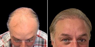 Hair Restoration  Before & After Gallery - Patient 144658912 - Image 2