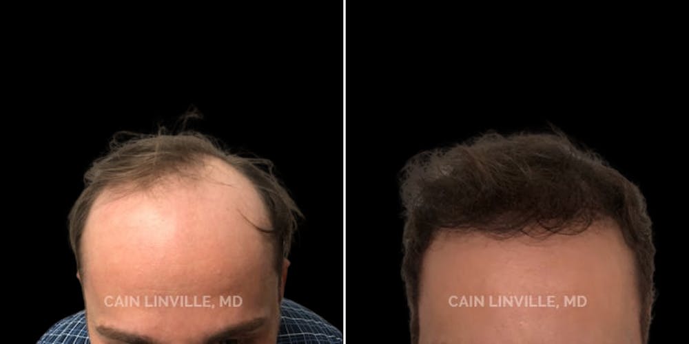 Hair Restoration  Before & After Gallery - Patient 144658914 - Image 1