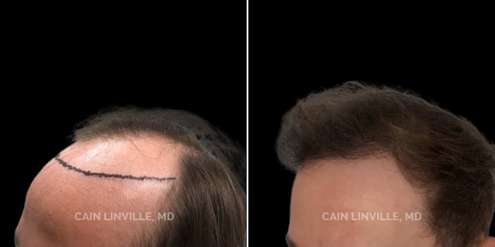 Hair Restoration  Before & After Gallery - Patient 144658914 - Image 2