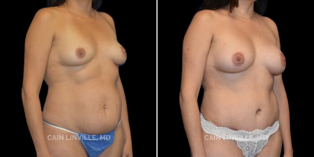 Mommy Makeover Before & After Gallery - Patient 8522317 - Image 3