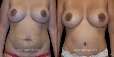 Mommy Makeover Before & After Gallery - Patient 8522333 - Image 1