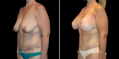 Mommy Makeover Before & After Gallery - Patient 8522343 - Image 1