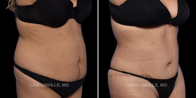 Mommy Makeover Before & After Gallery - Patient 149284336 - Image 6