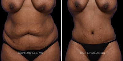 Mommy Makeover Before & After Gallery - Patient 149284337 - Image 1