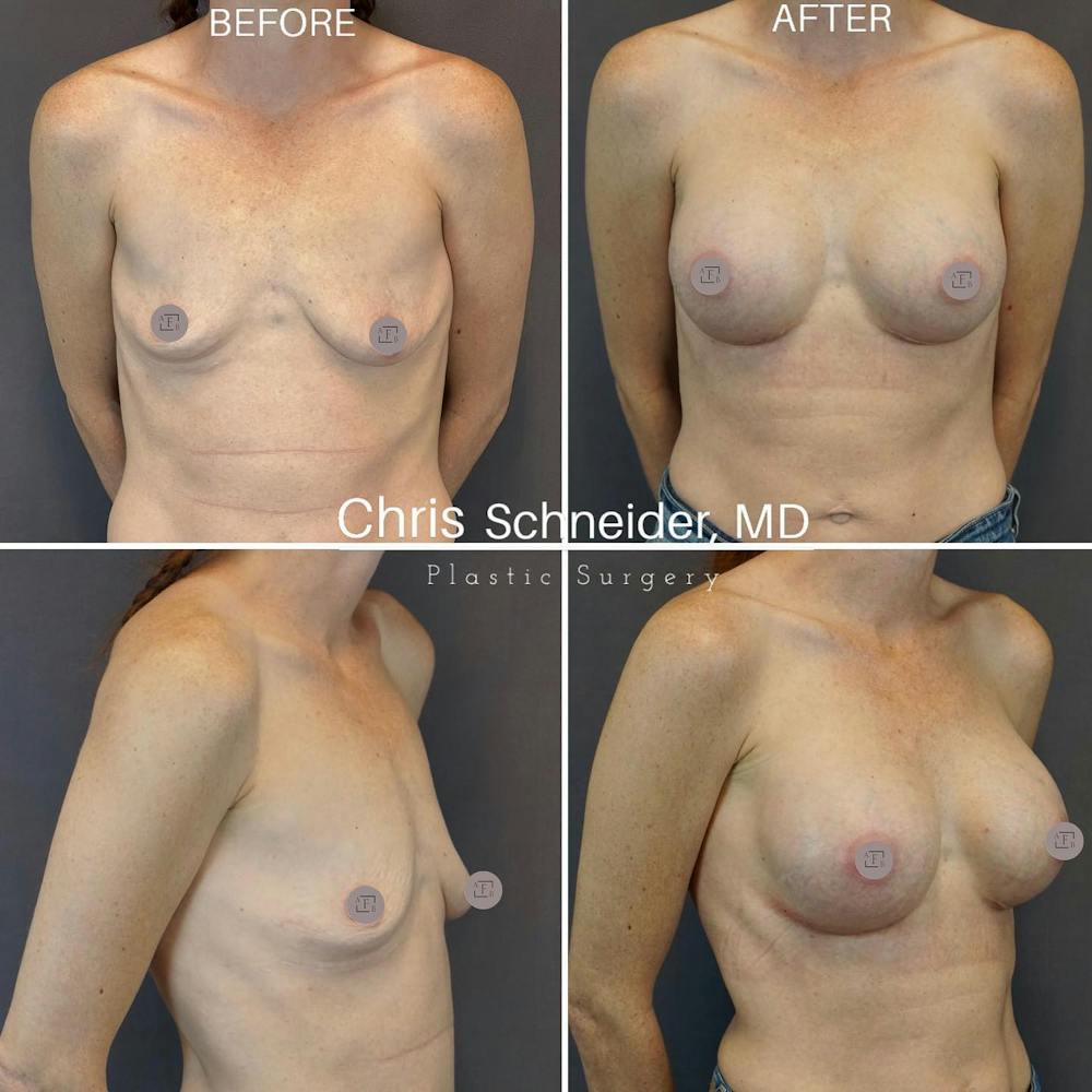 Breast Augmentation Before & After Gallery - Patient 149340545 - Image 1