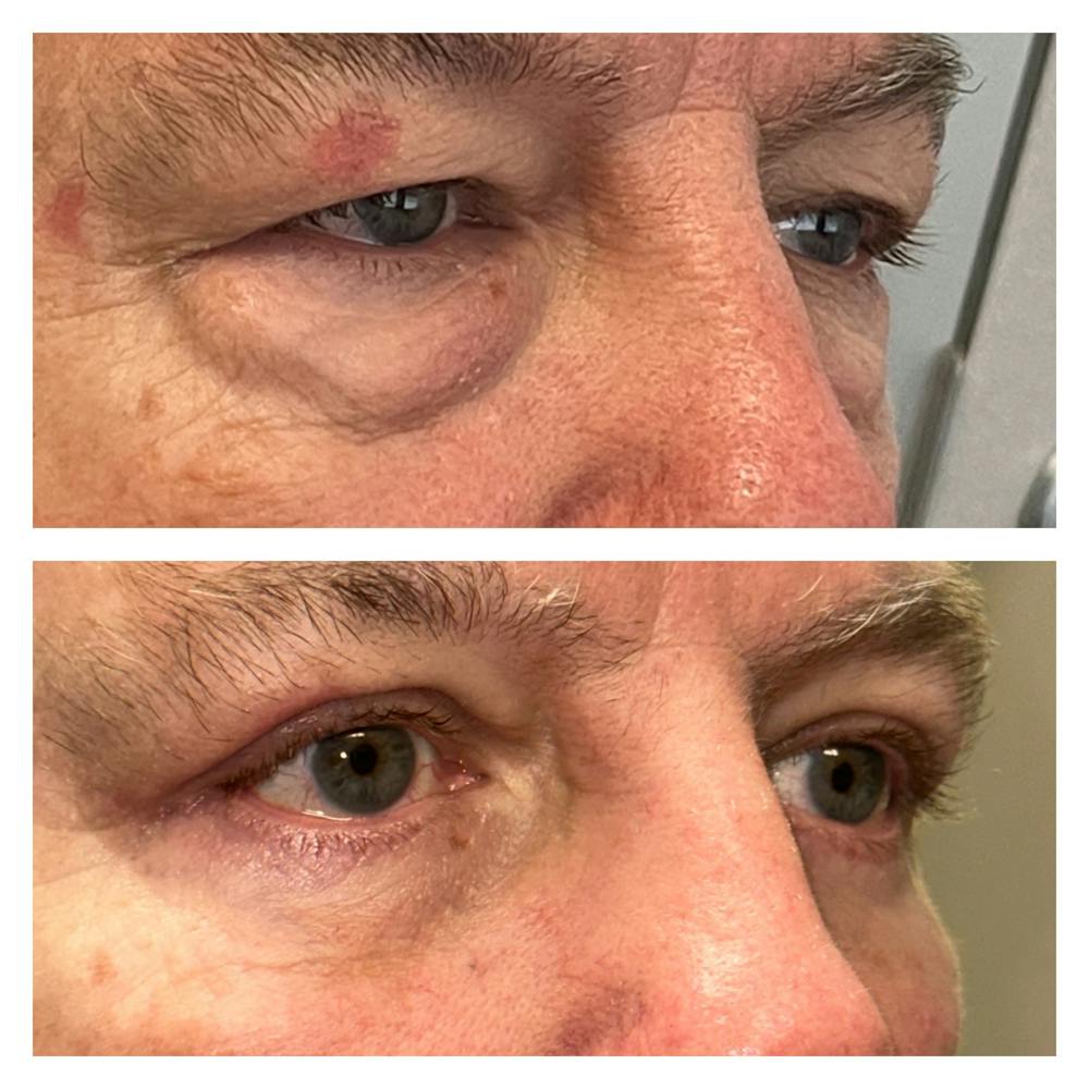 Lower Blepharoplasty Before & After Gallery - Patient 149385757 - Image 1