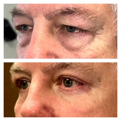Upper Blepharoplasty Before & After Gallery - Patient 149385756 - Image 2
