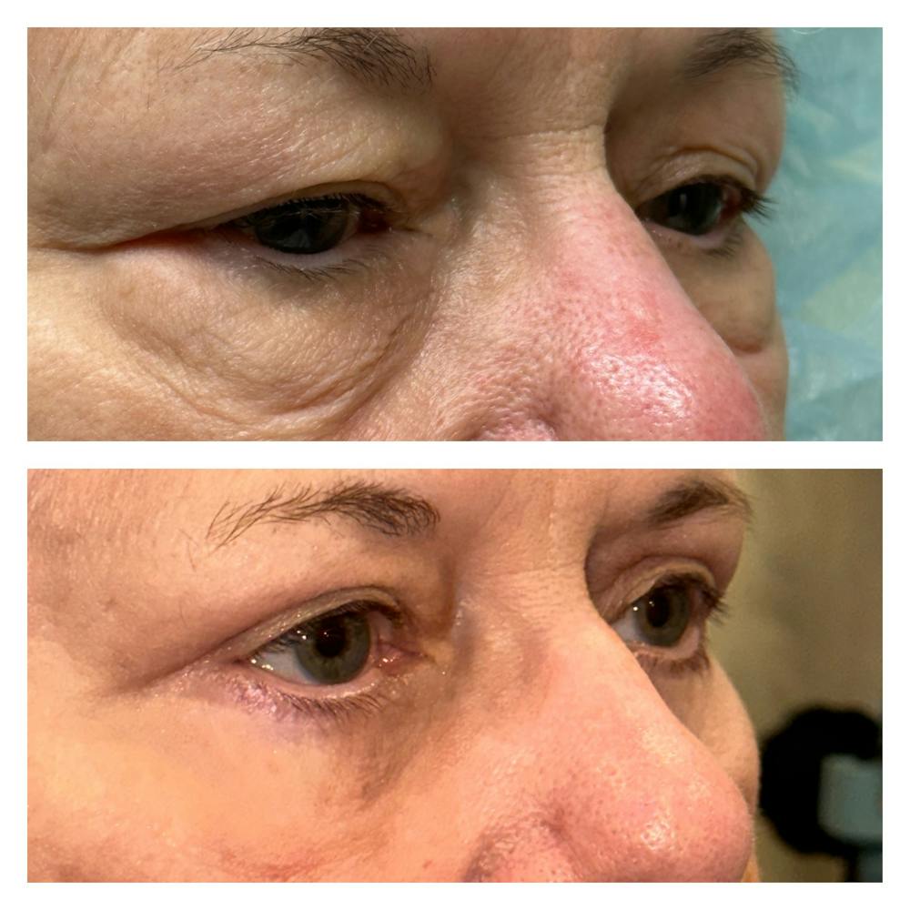 Lower Blepharoplasty Before & After Gallery - Patient 149385763 - Image 1