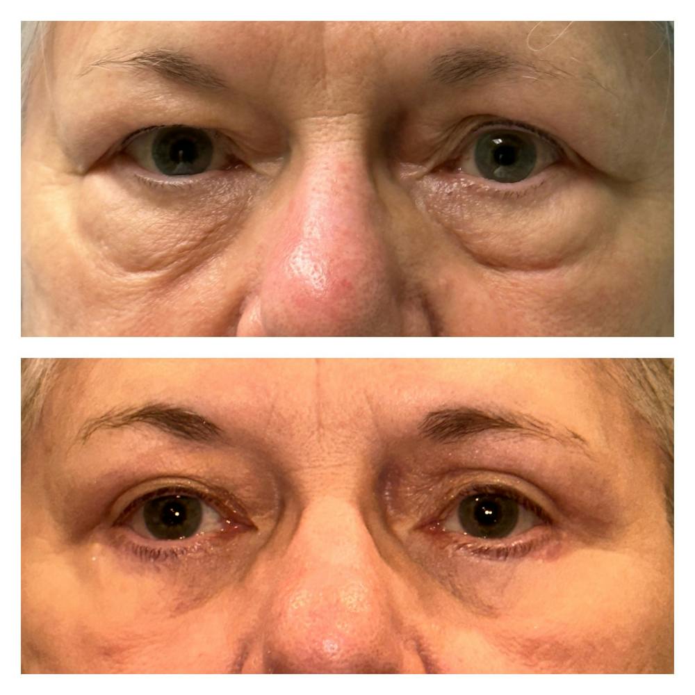 Lower Blepharoplasty Before & After Gallery - Patient 149385763 - Image 2
