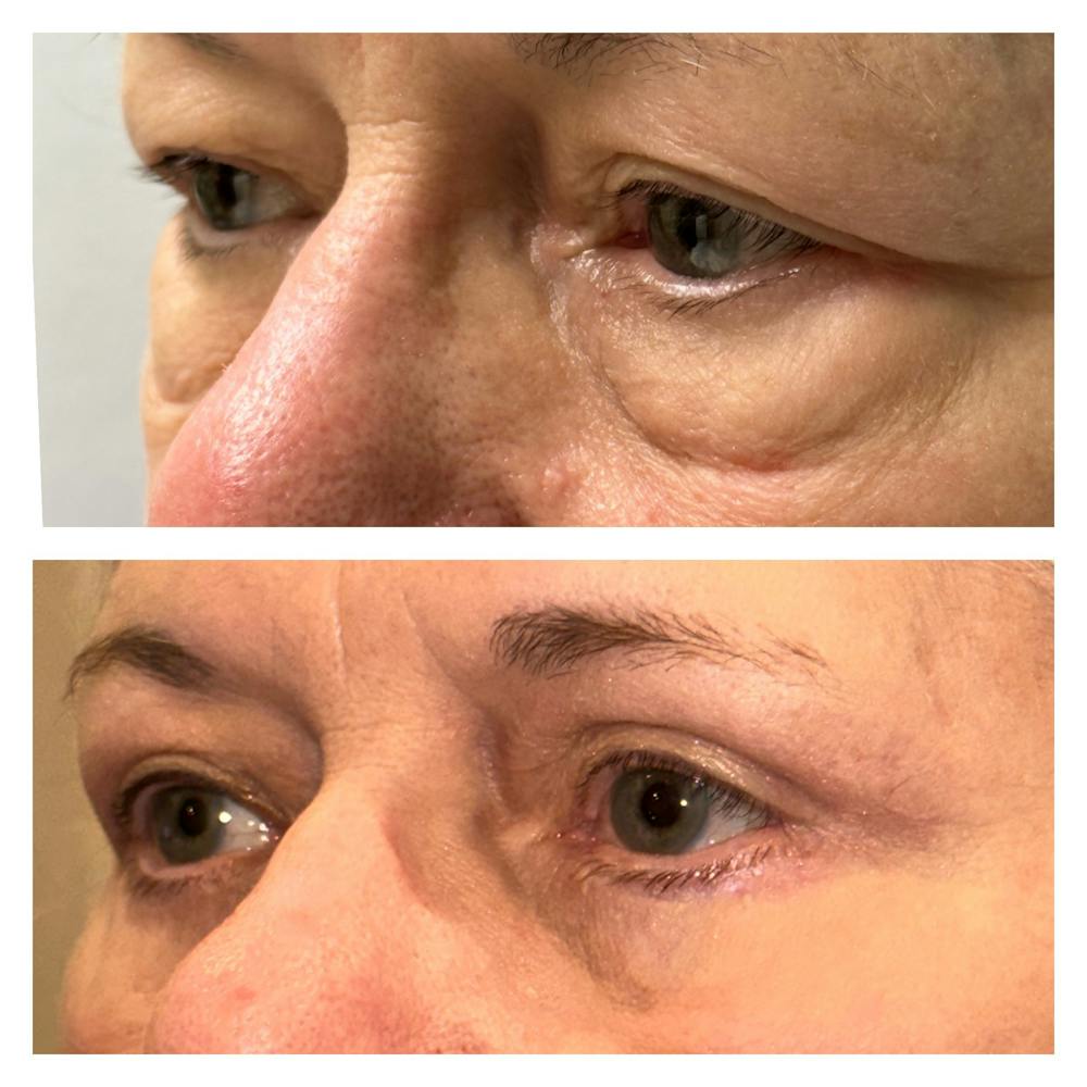 Lower Blepharoplasty Before & After Gallery - Patient 149385763 - Image 3