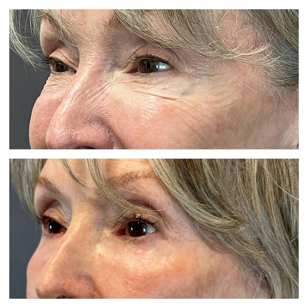 Upper Blepharoplasty Before & After Gallery - Patient 149385774 - Image 2