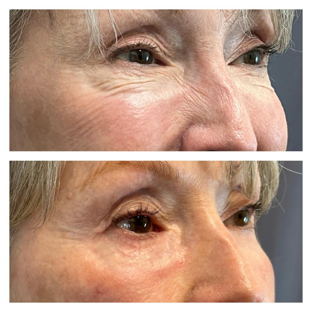 Lower Blepharoplasty Before & After Gallery - Patient 149385775 - Image 3