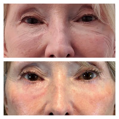 Lower Blepharoplasty Before & After Gallery - Patient 149385775 - Image 1
