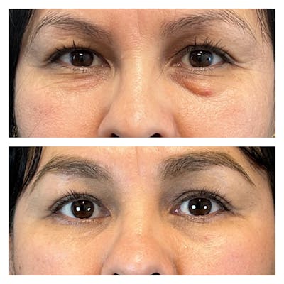 Lower Blepharoplasty Before & After Gallery - Patient 149385782 - Image 1