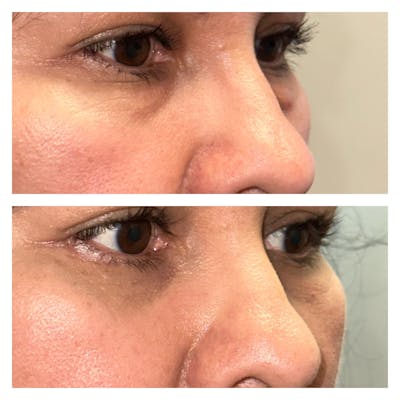 Lower Blepharoplasty Before & After Gallery - Patient 149385782 - Image 2