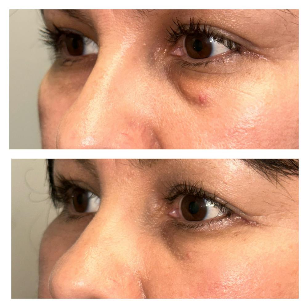 Lower Blepharoplasty Before & After Gallery - Patient 149385782 - Image 3