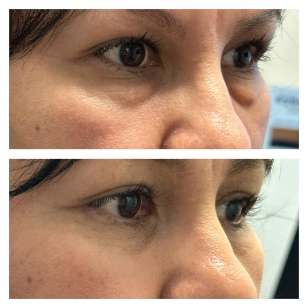 Lower Blepharoplasty Before & After Gallery - Patient 149385782 - Image 5