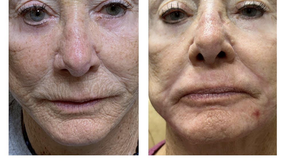 TRL Laser Before & After Gallery - Patient 149385784 - Image 1