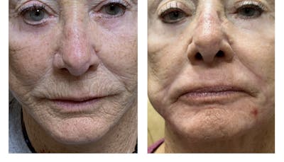 TRL Laser Before & After Gallery - Patient 149385784 - Image 1
