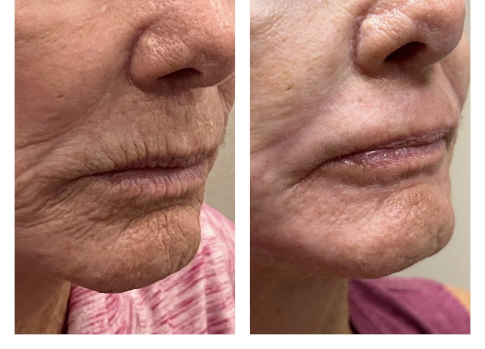 TRL Laser Before & After Gallery - Patient 149385784 - Image 3