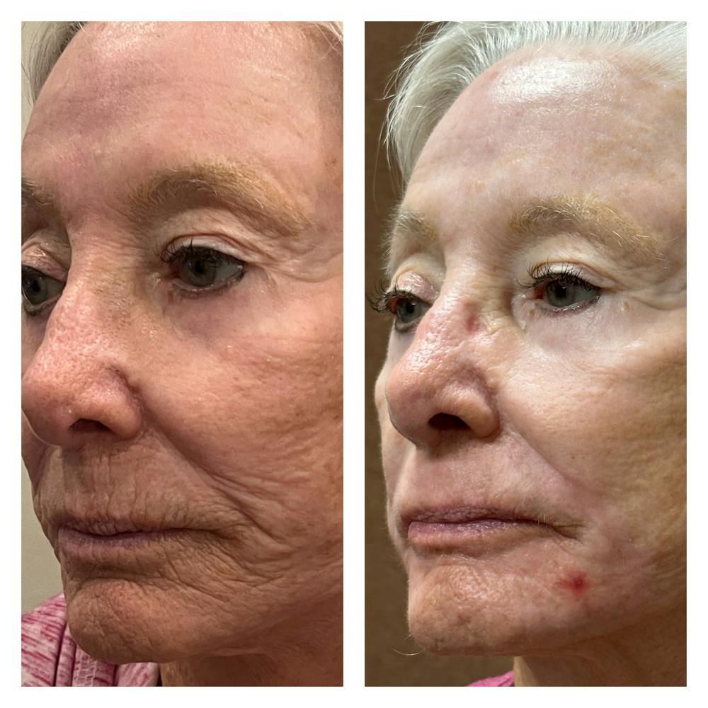 TRL Laser Before & After Gallery - Patient 149385784 - Image 4